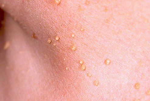 A skin tag is a small flap of flesh-colored or slightly darker tissue that hangs off the skin by a connecting stalk.