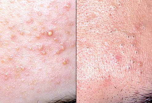 Acne pimples are a plug of fat, skin, and keratin. When open, the plug is called a blackhead, and when closed, a whitehead.