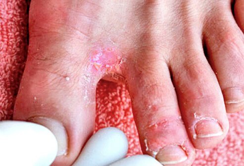 Interdigital, or toe web infection, is the most common kind of athlete's foot.