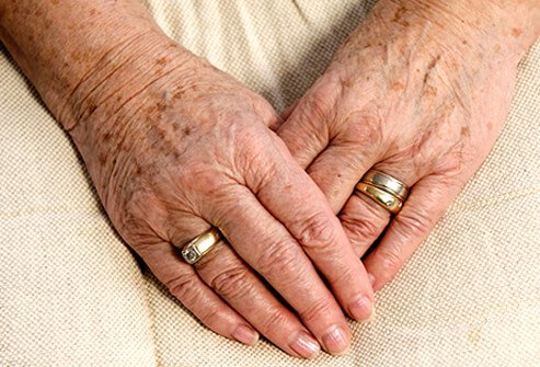 Age or liver spots are the result of sun exposure, which is why they tend to appear on areas that get a lot of sun.