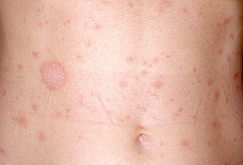 Pityriasis rosea causes salmon-colored ovals and appear on the arms, legs, back, chest, and abdomen, and sometimes the neck.
