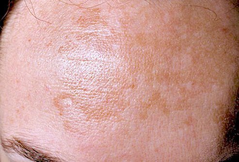 Melasma is characterized by tan or brown patches on the cheeks, nose, forehead, and chin.