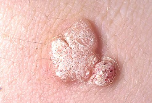 In most cases, common warts appear on the fingers or hands.
