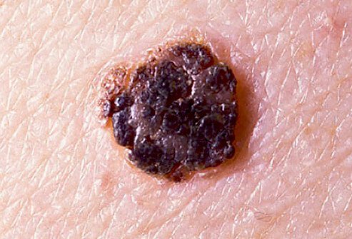 Seborrheic keratoses is a noncancerous growth that may be dark or multicolored, and usually have a grainy surface that easily crumbles.