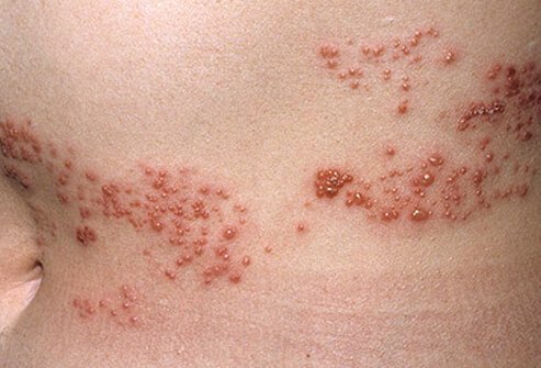 Shingles is a rash of raised dots that develops into painful blisters and lasts about two weeks.