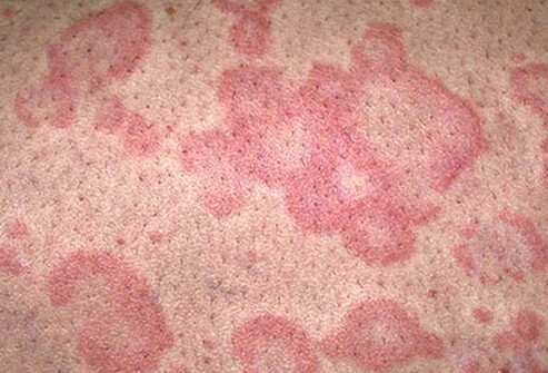 Hives vary in size and may join together to form larger areas.