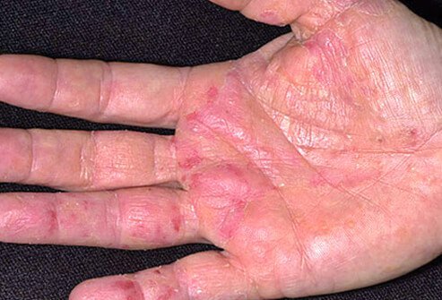 Stress, irritants (like soaps), allergens, and climate can trigger flare-ups of eczema.
