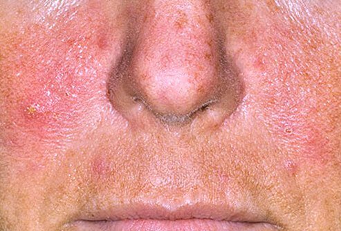 Rosacea causes redness on the nose, chin, cheeks, forehead, even in the eyes.