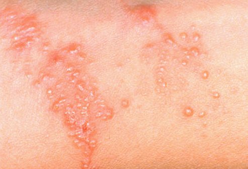 Contact with sap from poison ivy, oak, and sumac causes a rash in most people with blistering appearing within hours or a few days.