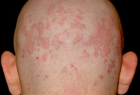 A photo of a man with seborrheic dermatitis.