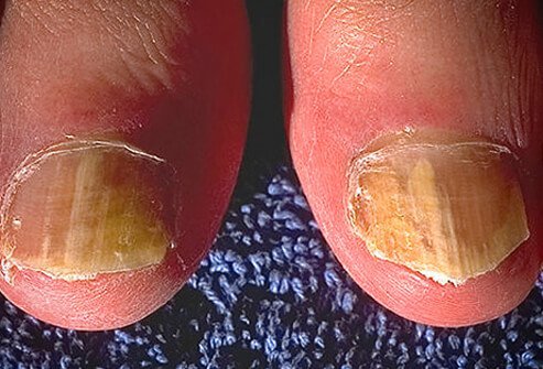 Ringworm of the nails (tinea unguium)