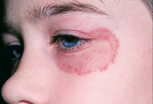 Ringworm of the face (tinea faciei)