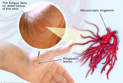 Ringworm fungi are known as dermatophytes.