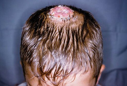 Ringworm of the scalp (tinea capitis)