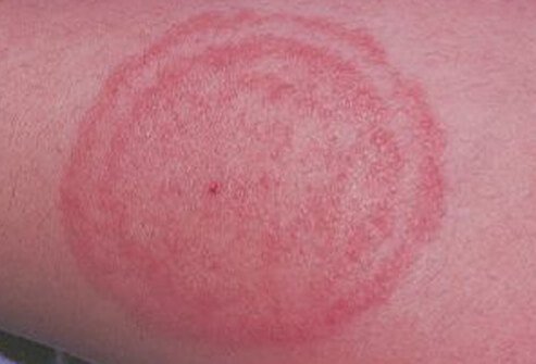 It is important to distinguish ringworm of the body (tinea corporis) from similar common rashes.