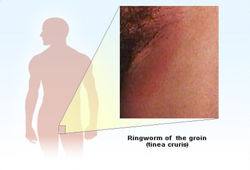 Ringworm of the groin (tinea cruris)