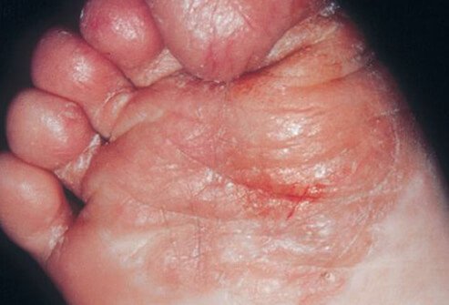 Ringworm of the foot (tinea pedis)