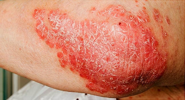 Image result for Disease